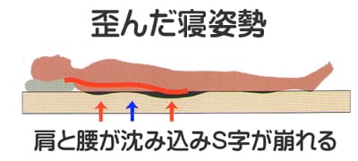 腰の部分が沈み込み過ぎた歪んだ寝姿勢